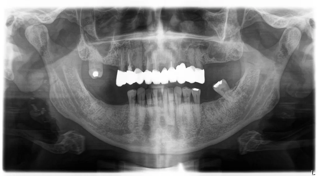 Abb. 5 a-h: Klinische und radiologische Dokumentation eines 57-jährigen männlichen Patienten (geb. 16.3.1968) mit dem PSI-Code 3, 4, 3, 3, 3, 3. Der Patient wurde über das Untersuchungsergebnis, den möglichen Behandlungsbedarf sowie (bei Messergebnis Code 3 oder 4) über die Notwendigkeit, einen klinischen und einen röntgenologischen Befund zu erheben, sowie die Diagnose zu stellen, informiert. Der Patient stellte sich in der Sprechstunde notfallmäßig mit Zahnschmerzen im Oberkiefer rechts vor. Er hatte vor fünf Jahren einen Herzinfarkt erlitten und einen Stent bekommen. Seither war er mit ASS 100 antikoaguliert. Dargestellt ist die Wundversorgung nach der Extraktion des Zahnes 18 mit einem Gelatineschwämmchen und adaptierenden Nähten bei einem Patienten, der Thrombozytenaggregationshemmer einnimmt.