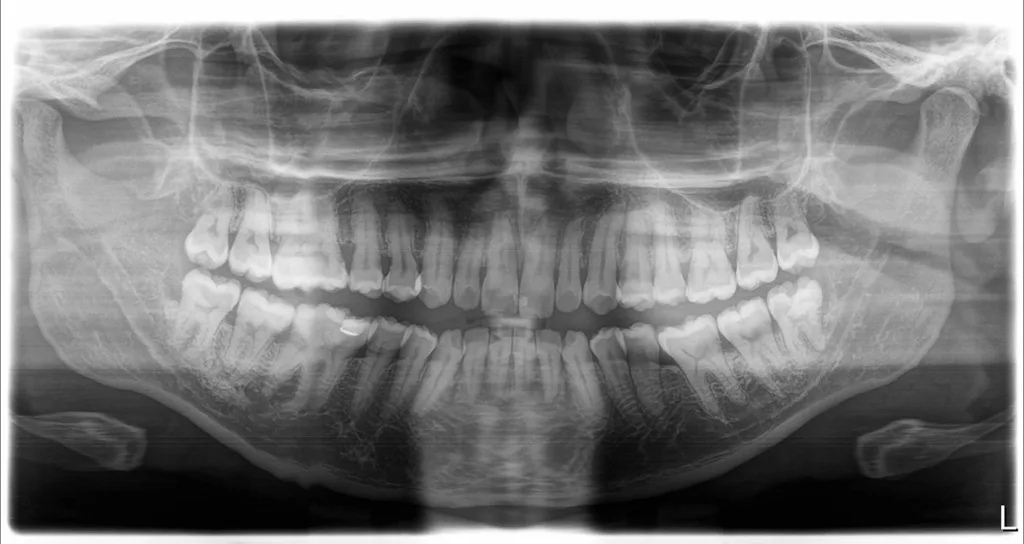 Abb. 6 a-f: Klinische und radiologische Dokumentation eines 32-jährigen männlichen Patienten (geb. 26.5.1992) mit generalisierter Parodontitis Stadium III Grad C. Im Laufe der AIT der Stufe 2 traten schwere (Nach-) Blutungen aus den instrumentierten Parodontien, die eine stationare Aufnahme erforderten. Im Laufe der AIT der Stufe 2 traten schwere (Nach-) Blutungen aus den instrumentierten Parodontien auf, die eine stationare Aufnahme erforderten, auf. Im Zuge der weiteren Abklärungen wurde initial zunächst die Verdachtsdiagnose einer Glanzmann-Thrombasthenie geäußert, die sich am Schluss der Untersuchungen nicht bestätigte [38].