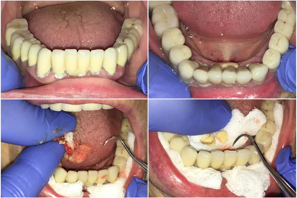 Abb. 1 a-j: Behandlung in der Häuslichkeit: Mit Mitteln der häuslichen Mundhygiene, zahnärztlichen Handinstrumenten, Kompressen (5 x 5 cm, achtlagig) und desinfizierenden Gelen lassen sich mit wenig Aufwand und geringem Risiko präventionsorientierte, aber auch parodontale Behandlungsmaßnahmen realisieren. (Hinweis: Nachdruck Quintessenz Teamjournal [14])