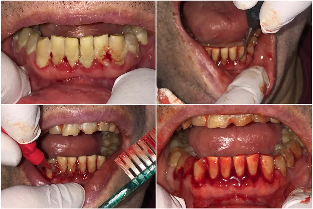Abb. 1 a-j: Behandlung in der Häuslichkeit: Mit Mitteln der häuslichen Mundhygiene, zahnärztlichen Handinstrumenten, Kompressen (5 x 5 cm, achtlagig) und desinfizierenden Gelen lassen sich mit wenig Aufwand und geringem Risiko präventionsorientierte, aber auch parodontale Behandlungsmaßnahmen realisieren. (Hinweis: Nachdruck Quintessenz Teamjournal [14])