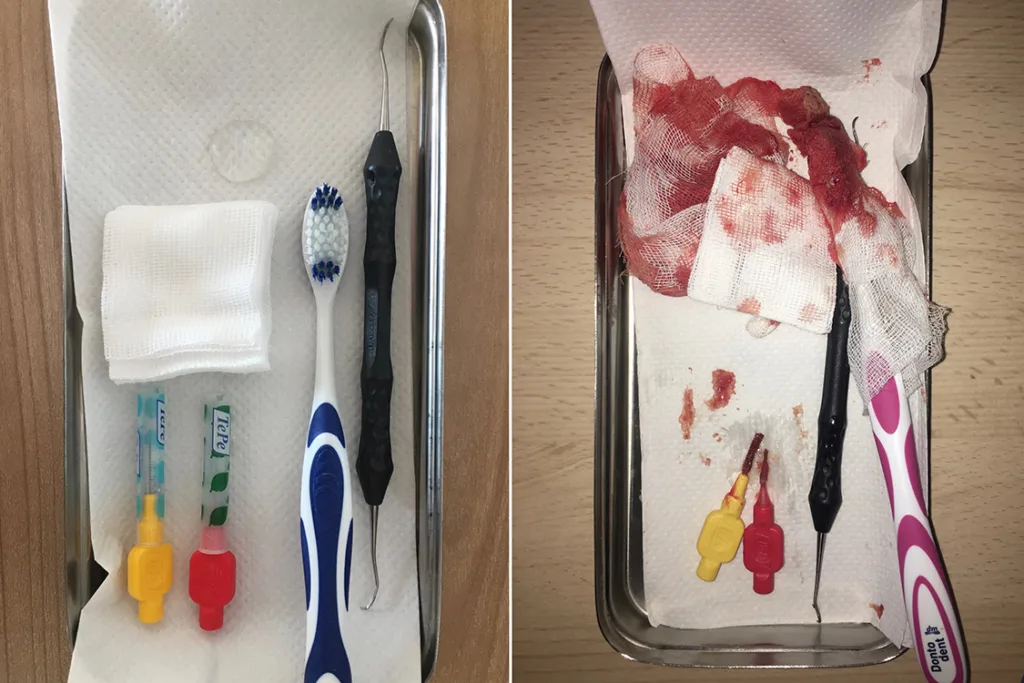 Abb. 1 a-j: Behandlung in der Häuslichkeit: Mit Mitteln der häuslichen Mundhygiene, zahnärztlichen Handinstrumenten, Kompressen (5 x 5 cm, achtlagig) und desinfizierenden Gelen lassen sich mit wenig Aufwand und geringem Risiko präventionsorientierte, aber auch parodontale Behandlungsmaßnahmen realisieren. (Hinweis: Nachdruck Quintessenz Teamjournal [14])