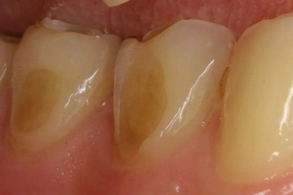 Abb. 3: Die bukkalen dentalen Erosionen sind verfärbt. Beachte die typische intakte Schmelzleiste bei der Gingiva, hervorgerufen auch durch die neutralisierende Wirkung der Sulkusflüssigkeit.