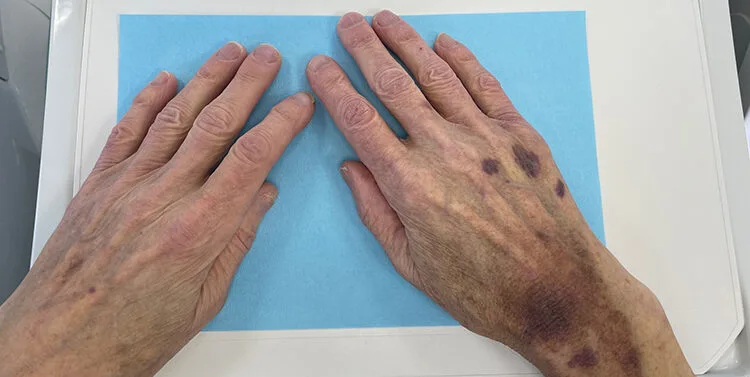Abb. 7: Die Hände dieses 81-jährigen Patienten fielen sofort auf. Aus der Anamnese gingen Herzrhythmusstörungen, ein Schlaganfall und „blaue Flecken auch ohne Verletzungen“ hervor. Aufgrund der kardiovaskulären Erkrankungen/ Ereignisse besteht eine gerinnungshemmende Medikation mit Xarelto® (20mg/ tgl.) einem DOAK mit dem Wirkstoff Rivaroxaban. Zuvor war der Patient mit Falithrom®, einem Vitamin-K-Antagonisten, eingestellt. Darüber hinaus besteht eine rheumatoide Erkrankung und eine Prednisolon Medikation. Die gemeinsame Einnahme von Kortikosteroiden und Antikoagulantien steigert das Risiko für Blutungen ganz erheblich. Aus der zahnärztlichen Krankengeschichte gingen geplante Extraktion einiger nicht mehr erhaltungswürdiger Zähne hervor. Der Patient hatte die Entfernungen mit Verweis auf „schlechte Erfahrungen“ im Sinne von (Nach-) Blutungen allerdings, trotz eigehender Aufklärung, abgelehnt.