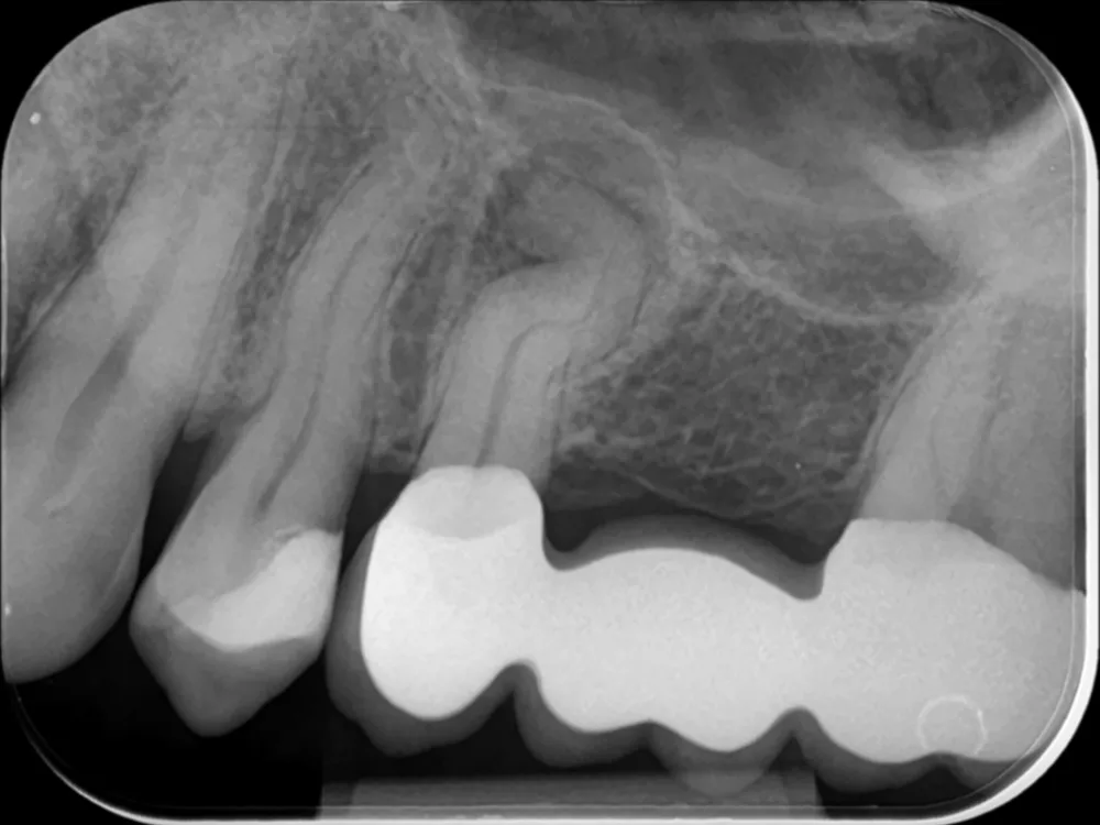 Abb. 11: Diagnostische Aufnahme Zahn 25.