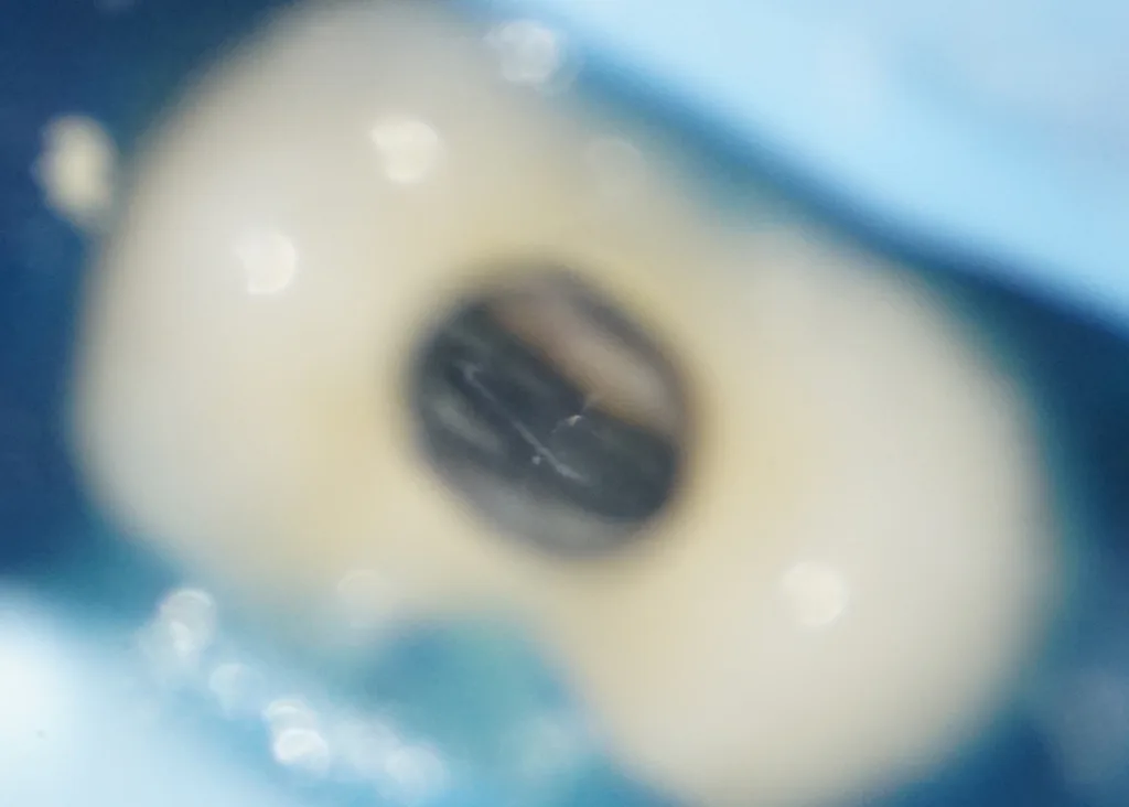 Abb. 13: Intrakoronale Diagnostik.
