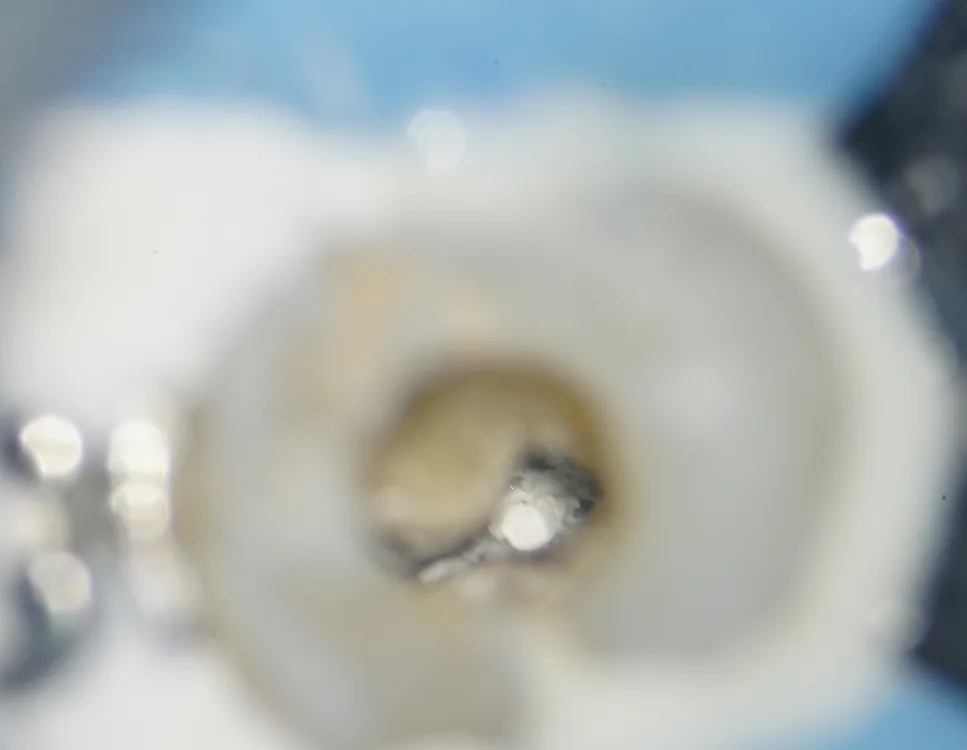 Abb. 7: Darstellung apikaler Plug.