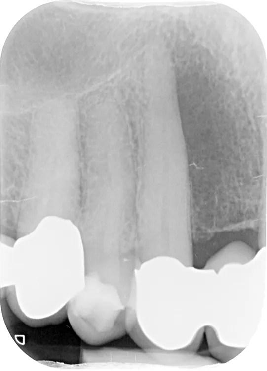 Abb. 1: EPL primär endodontischer Ätiologie Zahn 13.