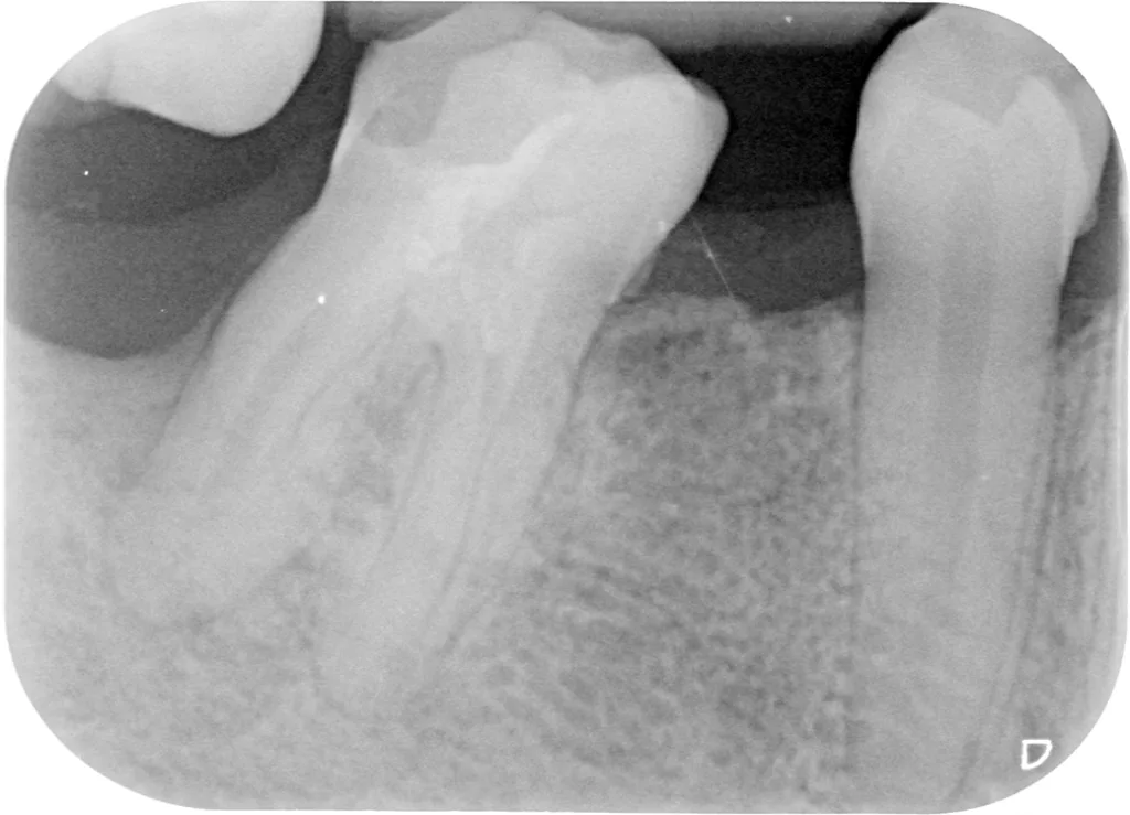 Abb. 3a u. b: EPL an Zahn 46 mit starker Kippung und vorhandenem Knochenabbau (1/2 WL) distal: Zustand vor und nach kombinierter endodontischer und parodontaler Behandlung.
