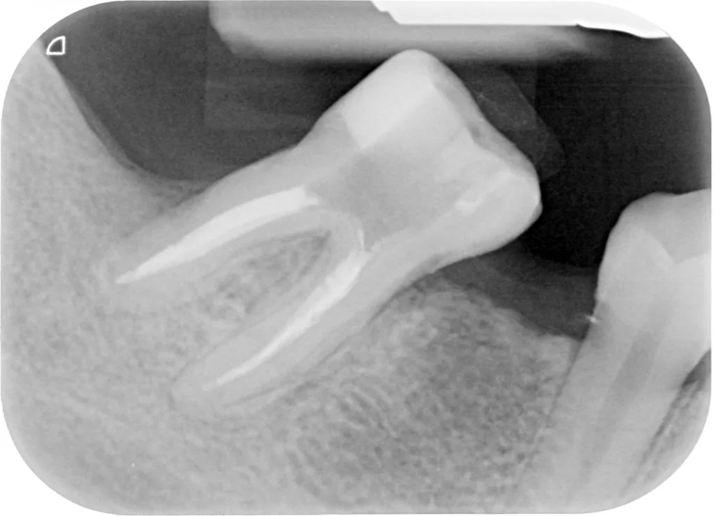 Abb. 3a u. b: EPL an Zahn 46 mit starker Kippung und vorhandenem Knochenabbau (1/2 WL) distal: Zustand vor und nach kombinierter endodontischer und parodontaler Behandlung.