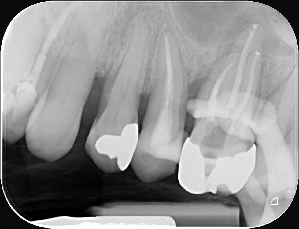 Abb. 9a–g: Fallbeispiel, röntgenologische Diagnostik im Behandlungsverlauf. g) Obturationskontrolle Zahn 26 9/2025.