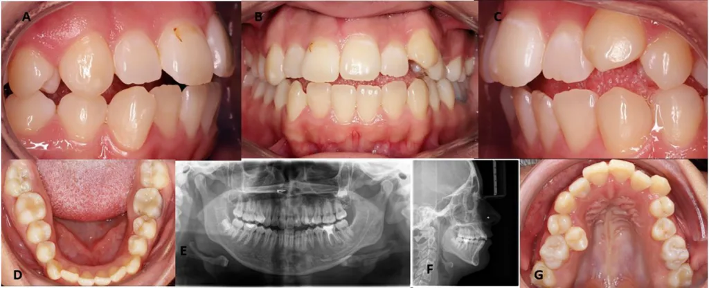 Abb. 3: Anfangsbefund einer 18-jährigen Patienten mit systemischem Herzfehler. Die intraoralen Fotos (a–d; g) zeigen eine Platzmangelsituation in beiden Kiefern mit frontal offenem Biss und weisen auf eine bestehende Gingivitis hin. Das Orthopantomogramm (e) zeigt ein vollständig angelegtes, konservierend saniertes Gebiss, mit einem endodontisch versorgten Zahn 36. Auf dem FRS (f) sieht man eine tendenziell distal-basale Diskrepanz sowie protrudierte Fronten.