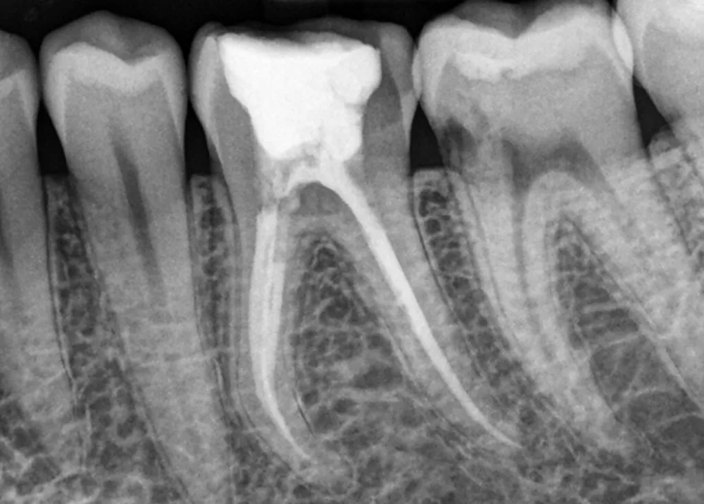 Abb. 1: Diagnostischer Zahnfilm mit Verdacht auf Resorption an Zahn 37.