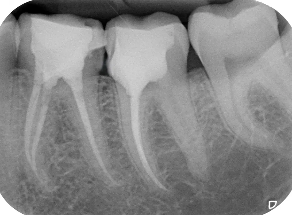 Abb. 11: Röntgenkontrollaufnahme nach Abschluss der Wurzelfüllung; direkte Überkappung mit Biodentine (geringe Röntgenopazität) am distalen Kanaleingang.