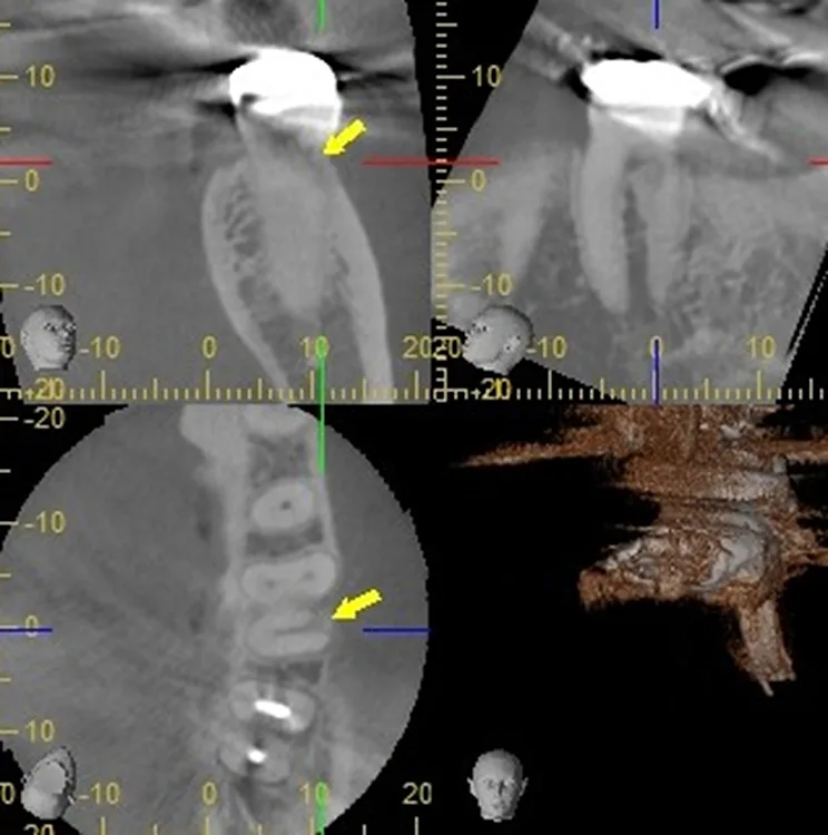 Abb. 13: Darstellung des Resorptionsprozesses an der distolingualen Wurzelkontur.