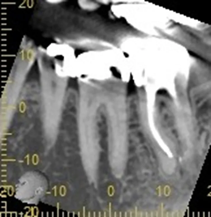 Abb. 19 a u. b: Präoperativer und postoperativer Schnitt mit periapikal vergrößertem Spongiosaraum.