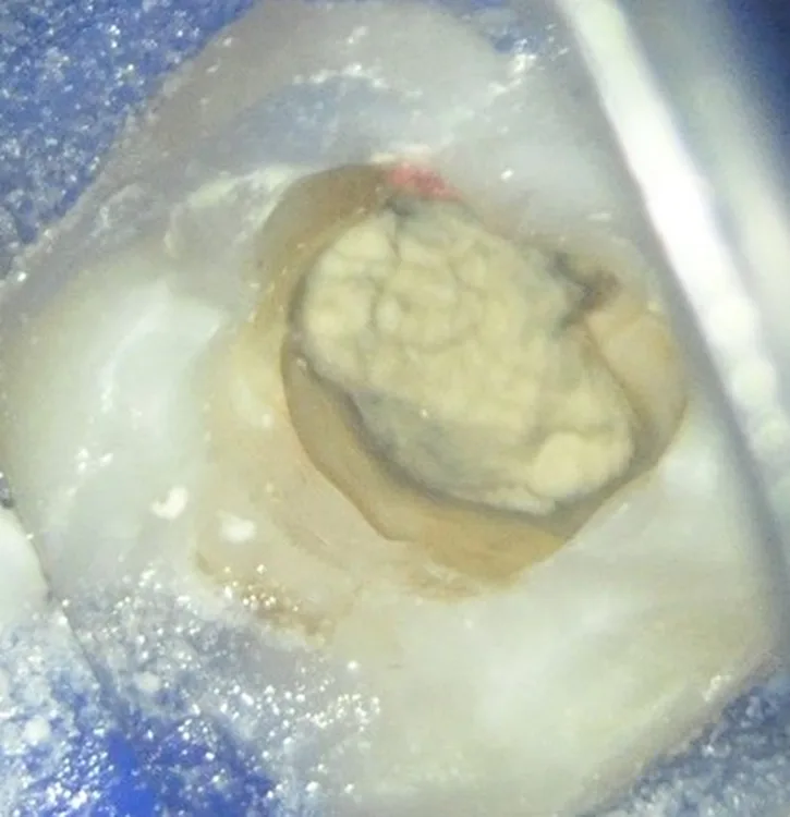 Abb. 5: Biodentin in situ am distalen Orificium.