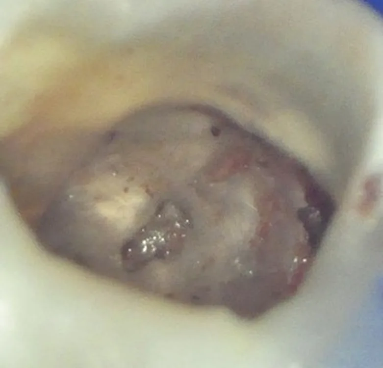 Abb. 8: Resorptionslakunen, morphologisch verändertes Dentin mit Restgewebe.