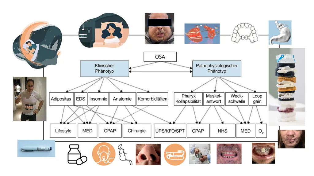 Abb. 19: Therapieoptionen nach klinischen und pathophysiologischen Kriterien. EDS*: exzessive Tagesmüdigkeit, SPT*: Schlafpositionstraining, NHS*: Nervus-hypoglossus-Stimulation.