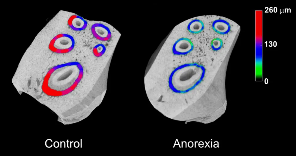 Abb. 2: Exemplarische Darstellung des Parodontalligaments bei Anorexia nervosa. Ausschnitte aus mikro-computertomographischen Untersuchungen im Rattenmodell mit Aktivitäts-basierter Anorexie (ABA) deuten auf eine Ausdünnung des parodontalen Ligaments (PDL) des ersten Molaren im Oberkiefer im Vergleich zur Kontrollgruppe hin (grün = ausgedünnte Bereiche, blau = mittlere Bereiche, rot = stärkere Bereiche).