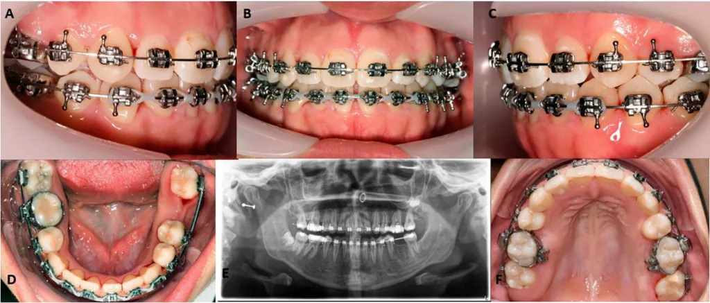 Abb. 4: Zwischenbefund nach Extraktion von drei Prämolaren, einem 6er und laufendem Lückenschluss mit Multibracketapparatur und Gummiketten. Intraoraler Fotostatus: a: bukkal von rechts, b: frontal geschlossen, c: bukkal von links, d: Unterkiefer-Aufsicht, e: Orthopantomogramm, f: Oberkiefer-Aufsicht