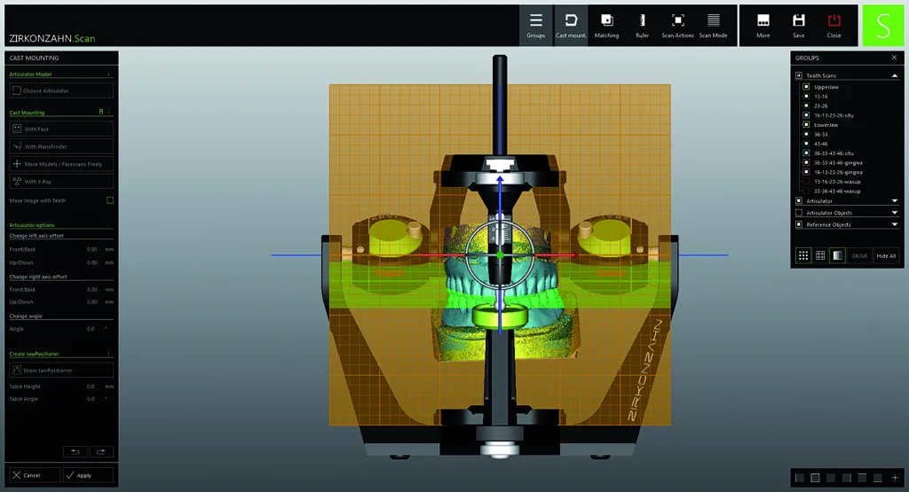 Abb. 2: Der Prototyp im virtuellen Artikulator. Die Modellscans und die Abformungen der getragenen herausnehmbaren Prothesen wurden verwendet, um die Einstellungen des Artikulators anzupassen und die korrekte vertikale Dimension der neuen Versorgung zu finden.