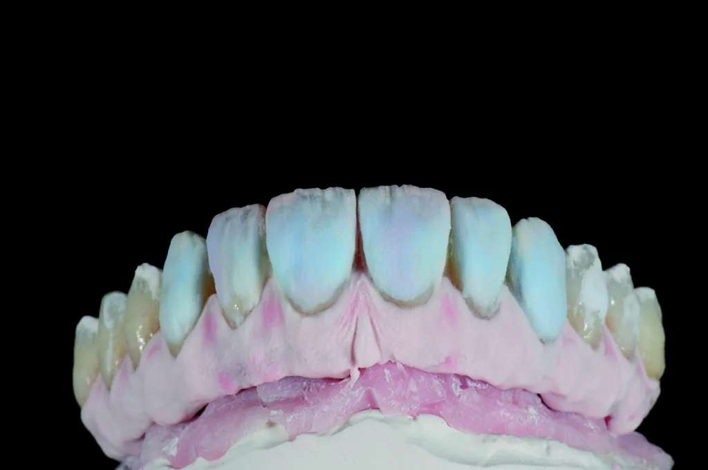 Abb. 22: Zweite Schicht ICE Ceramics auf den gingivalen und nicht funktionellen Bereichen zur Strukturierung der Zahnform
