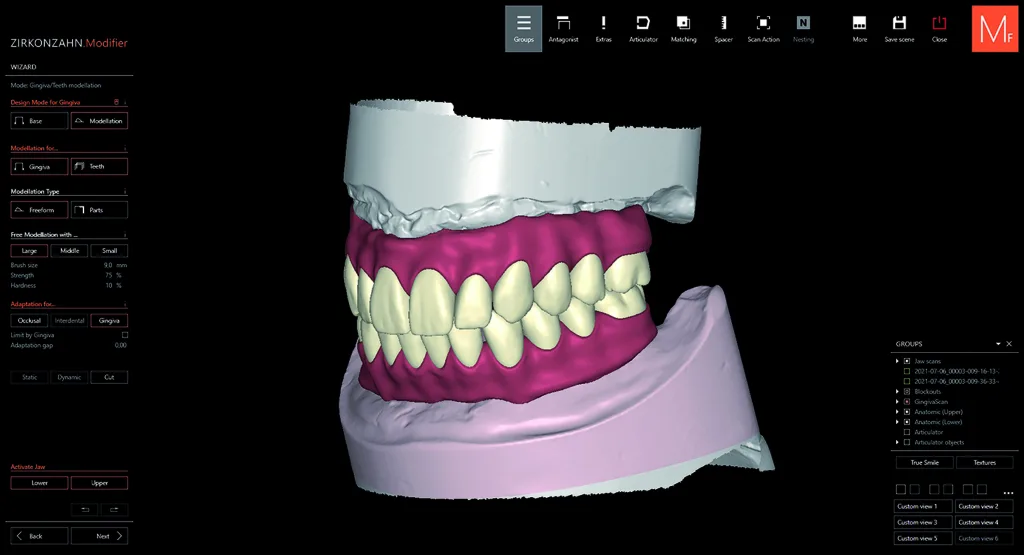 Abb. 3: In der Software Zirkonzahn.Modifier wurden die Zahnformen aus den verfügbaren virtuellen Bibliotheken ausgewählt. Die Gingiva wurde automatisch angewendet, nachdem die Software die Zahnhälse identifiziert hatte, sodass nur geringe Anpassungen nötig waren.