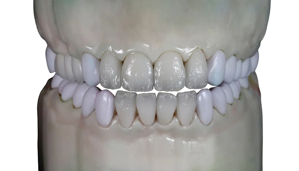 Abb. 11: IPS e.max ZirCAD Prime-Brücke und kaulasttragende monolithische Kronen im Seitenzahnbereich, IPS e.max CAD-Restaurationen mit individuellem Cut-back (nach dem ersten Brand) im Frontzahnbereich