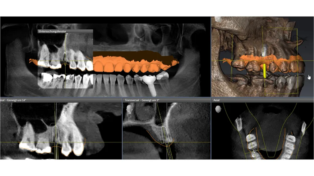 Abb. 10: Virtuelle Implantatplanung in der SICAT-Software mittels KI.