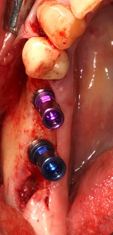 Abb. 12: Implantatpositionen gemäß digitaler Planung (Okklusalansicht).