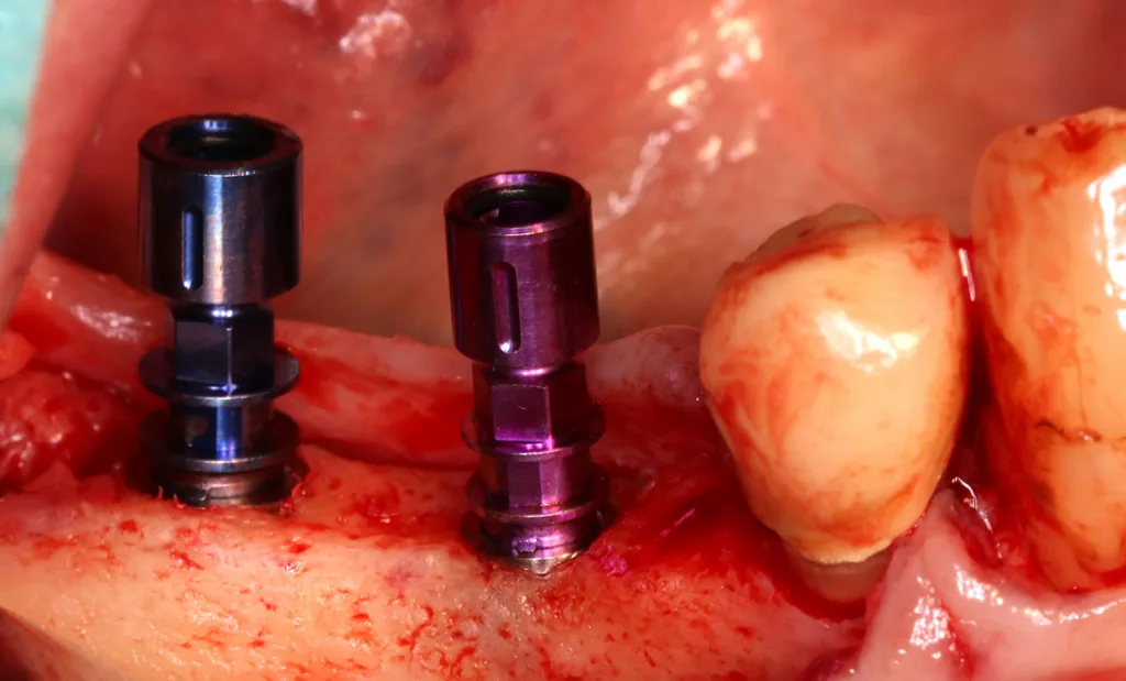 Abb. 13: Implantatpositionen gemäß digitaler Planung (Lateralansicht).