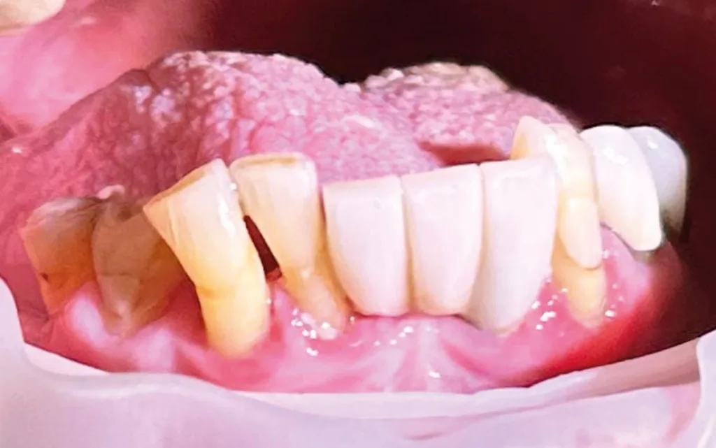 Abb. 6: Zustand nach drei Tagen mit einmal täglichem gründlichem Zähneputzen mit Interdentalhygiene
