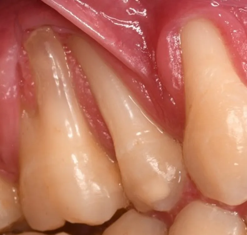 Abb. 1: Selbst ausgeprägte bukkale Rezessionen führen nicht zwangsläufig zu erhöhter Zahnbeweglichkeit, da die parodontale Verankerung über mesiale, distale und orale Flächen erhalten bleibt. Als Folge einer retrograden Infektion kommt es allerdings meistens zu einer Pulpennekrose.