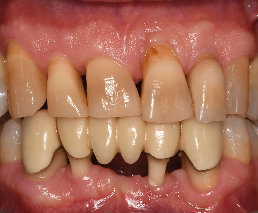 Abb. 2: Von einer Rezession spricht man, wenn der Gingivarand apikal der Schmelz Zement-Grenze liegt. Nach einer Parodontaltherapie passt sich die Gingiva dem verringerten knöchernen Niveau an, wodurch Wurzeloberflächen zirkulär sichtbar werden. Charakteristisch ist hierbei der Verlust der Papillen. Davon zu unterscheiden sind die rein gingivalen Rezessionen; dabei bleiben die approximalen Knochen- und Weichgewebsstrukturen weitgehend erhalten; die Defekte zeigen sich typischerweise an den bukkalen oder lingualen Flächen einzelner Zähne.