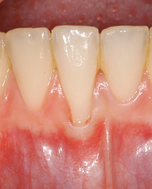 Abb. 3 a-c: Klassifikation gingivaler Rezessionen [8]. a. RT1: Gingivarezession ohne interproximalen Attachmentverlust; interproximale Schmelz-Zement-Grenze klinisch nicht nachweisbar.