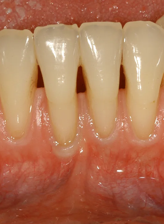 b. RT2: Gingivarezession mit interproximalem Attachmentverlust ≤ bukkalem Attachmentverlust.