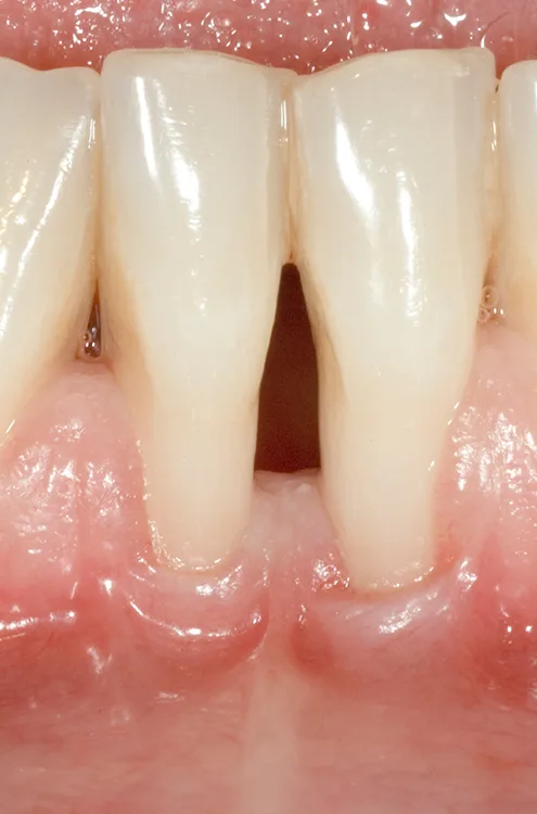 c. RT3: Gingivarezession mit interproximalem Attachmentverlust > bukkalem Attachmentverlust.