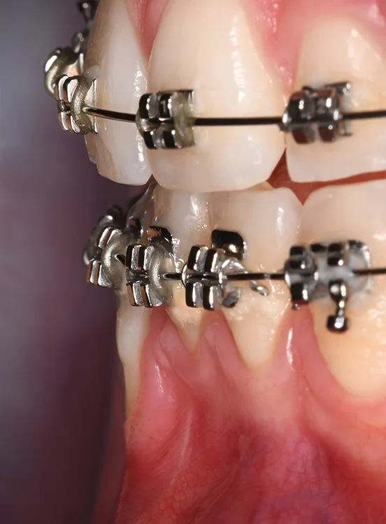 Abb. 4: Knochendehiszenzen gelten als conditio sine qua non für die Entstehung gingivaler Rezessionen. Steht ein Zahn mit der Kurvatur seiner Wurzel bukkal der knöchernen Alveolarknochen-spange, fehlt die bukkale Knochenbedeckung, man spricht von einer Knochendehiszenz. Durch eine kieferorthopädische Behandlung kann die Wurzel in die Alveolarknochenspange repositioniert werden, die Rezession bildet sich zurück.