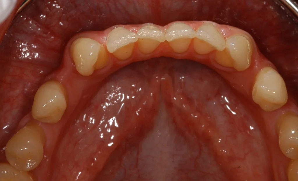 Abb. 5: Knochendehiszenzen gelten als conditio sine qua non für die Entstehung gingivaler Rezessionen. Bei einer ausgeprägten Wurzelkonvexität im Zusammenhang mit einer anatomisch dünnen Alveolarknochenspange sind die Wurzeloberflächen bukkal und/oder lingual ebenfalls nicht von Knochen bedeckt.