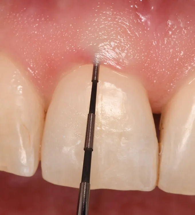 Abb. 6 a-b: Der gingivale Phänotyp kann auf standardisierte und reproduzierbare Weise beurteilt werden [8]. a. Um die Gingivadicke zu messen, wird eine Parodontalsonde in den Sulkus eingeführt. Scheint die Sonde durch das Gewebe durch, spricht man von einem dünnen Phänotyp (≤1 mm); ist die Sonde nicht sichtbar, handelt es sich um einen dicken Phänotyp (>1 mm).