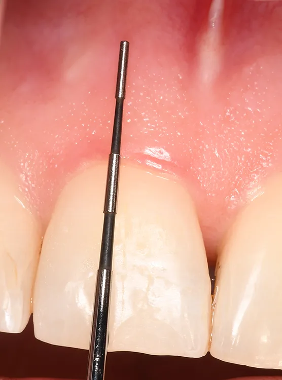 b. Die Breite der keratinisierten Gingiva wird vom Gingivarand zur mukogingivalen Linie gemessen. Eine Mindestbreite von ≥ 2 mm ist mit einer höheren Weichgewebsstabilität und einem geringeren Progressions- bzw. Rezidivrisiko assoziiert [2].