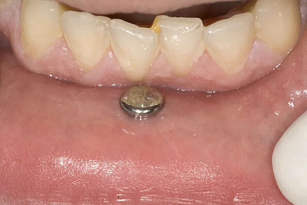 Abb. 8: Risiko gingivaler Rezessionen bei Lippenpiercings. Wenn speziell bei medianen Lippenpiercings der intraorale Verschluss auf Höhe des Margo gingivae liegt, ist das Risiko für Gingivarezessionen hoch.