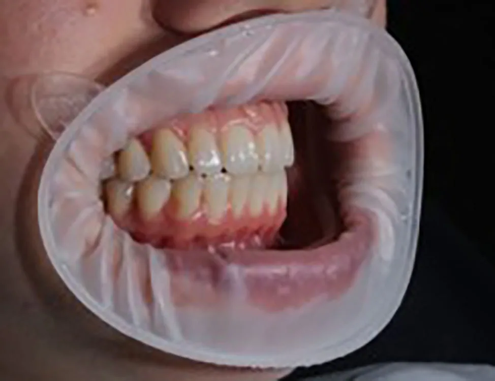Abb. 2: Trockenes Arbeitsumfeld, bspw. durch Lippen-Wangen-Halter.