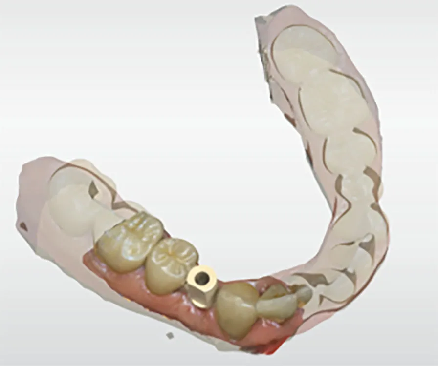 Abb. 3: Intraoralscan zur Herstellung einer Implantat-getragenen Einzelzahnrestauration.