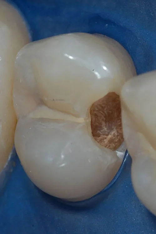 Abb. 1: Fragliches klinisches „Beispielbild“ der DGZ zum Thema selektive Kariesentfernung. Frage: Was passiert mit der C distal?