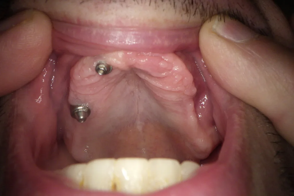 Abb. 2: Oralansichten: Ein Implantat ist nicht mehr sichtbar, ein Implantat blutend in der Umschlagfalte
