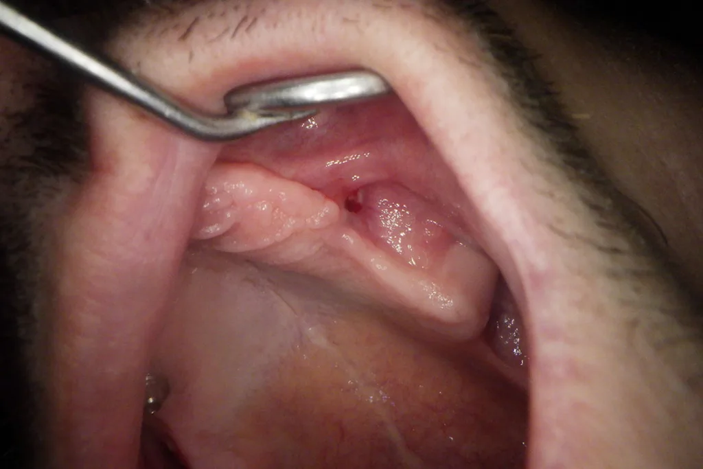 Abb. 3: Oralansichten: Ein Implantat ist nicht mehr sichtbar, ein Implantat blutend in der Umschlagfalte