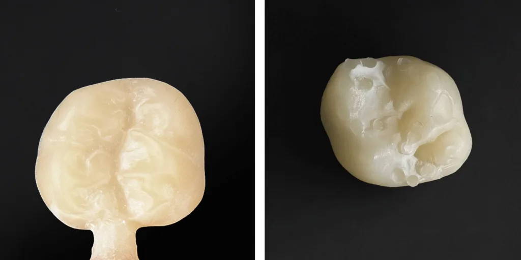 Eine Krone direkt nach dem Fräsen (links) bzw. Drucken (rechts). Beim Fräsen bleibt ein Haltesteg stehen, der vergleichsweise unauffällig seitlich am Werkstück angebracht ist und sich leicht von Hand entfernen lässt. 
Die Stützstruktur des 3D-Drucks besteht aus dünnen Stegen, die sich häufig direkt auf der Kaufläche befinden. Deren Entfernung gestaltet sich deutlich schwieriger. Reste des Druckharzes sind als weiße Schicht erkennbar.