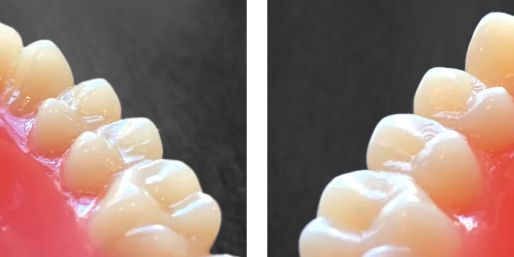 Gefräste Prothesenzähne (links) und gedruckte Prothesenzähne (rechts): Deutlich zu erkennen ist der schichtweise Aufbau des Drucks. Die entstandenen Stufen müssen beim 3D-Druck manuell geglättet werden, um vermehrter Plaquebildung entgegenzuwirken.