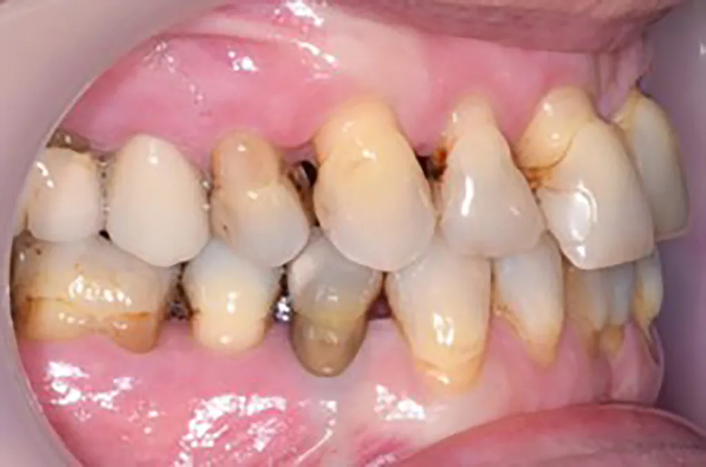 Abb. 4 a–e: Klinische Situation nach Erreichen des parodontalen Therapieziels (pocket closure) und vor Beginn der kieferorthopädischen Therapie. Im Bereich der OK- und UK-Front sind Engstände, Rotationen, Suprapositionen und schwarze Dreiecke mit den durch den Knochenverlust bedingten höhenreduzierten Papillen. PA-Therapie: Daniel Hagenfeld. KFO-Therapie: Jonas Q. Schmid.